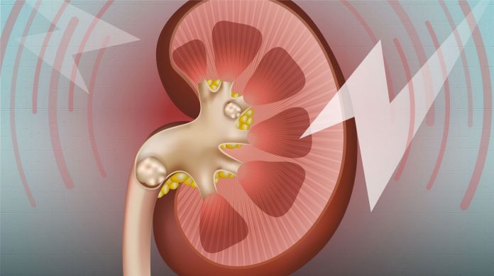 kidney stone treatment updates